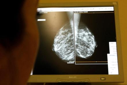 Mammograms should start at 40, task force recommends: asset-mezzanine-16x9
