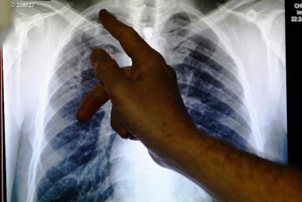 New drugs may stop TB, world's top infectious killer: asset-mezzanine-16x9